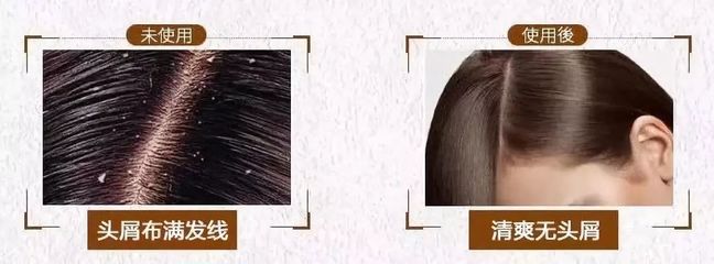 告別脫發、頭皮屑與頭發稀少的煩惱，重塑烏黑濃密的秀發